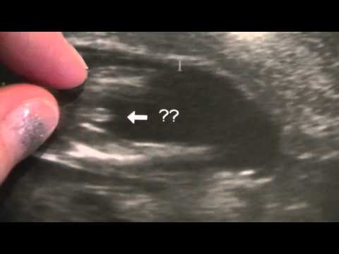 Ultrasound Proves Boy at 12 Weeks!