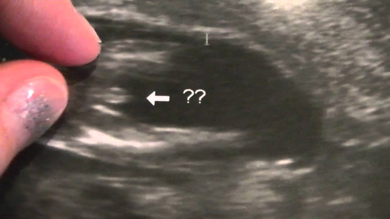 13 gender weeks at ultrasound Gender at