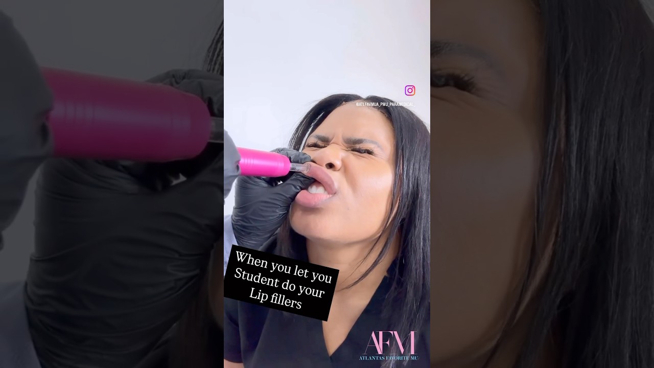How to do lip fillers with hyaluron pen ? | Needless Lip fillers 