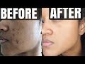 How To REALLY Get Rid of Stubborn Acne | Victoria Victoria