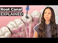 What Is A Root Canal & Should You Get One