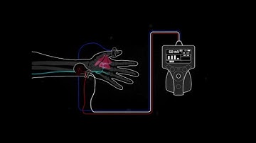 Train of Four Monitoring using the Ulnar Nerve