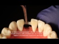 Мостовидные протезы  передних зубов при помощи Ribbond
