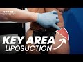 Liposuction Technique Unlocks the Key to a Round Butt | BTM5 EP9