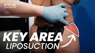 Liposuction Technique Unlocks the Key to a Round Butt | BTM5 EP9