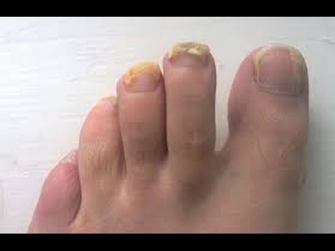 ¿qué-es-la-diabetes-mellitus-tipo-1?