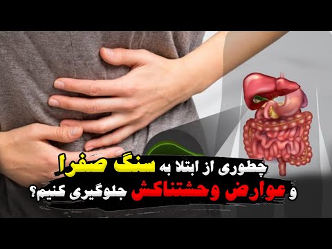 چطوری از ابتلا به سنگ صفرا و عوارض وحشتناکش جلوگیری کنیم