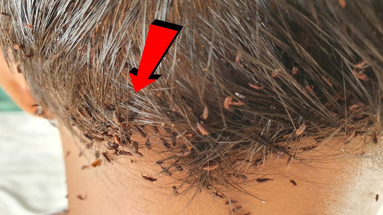 Extremely damaged giant lice from short hair Lice removal YouTube