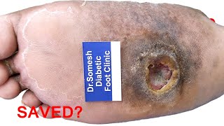 Diabetic Foot Ulcer  | Charcot midfoot ulcer  Before After  shorts