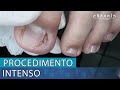 PROCEDIMENTO INTENSO | GRANULOMA, ONICOCRIPTOSE E UNHA EM LEQUE NOS DOIS DEDOS