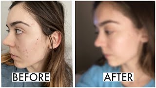 My experience with Curology! *how I got clear skin in 2 months!!