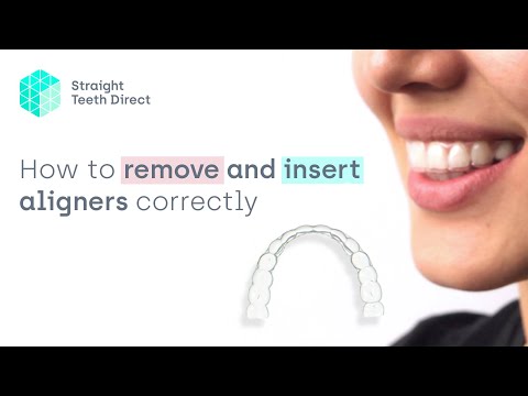 Video: Zijn interne aligners verwijderbaar?