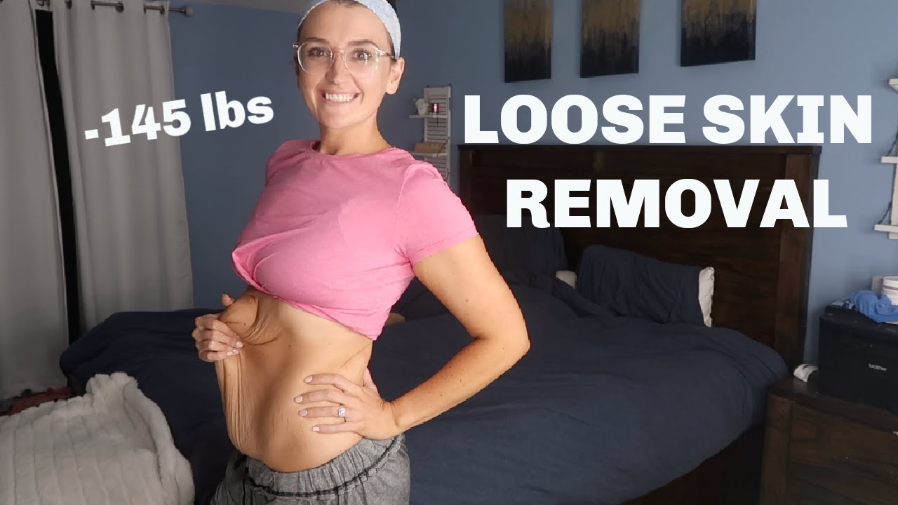 GETTING MY SKIN REMOVED, -145 LB WEIGHT LOSS