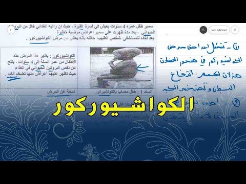 علوم طبيعية للسنة الاولى متوسط تمرين على امراض سوء التغذية الكواشيوركور