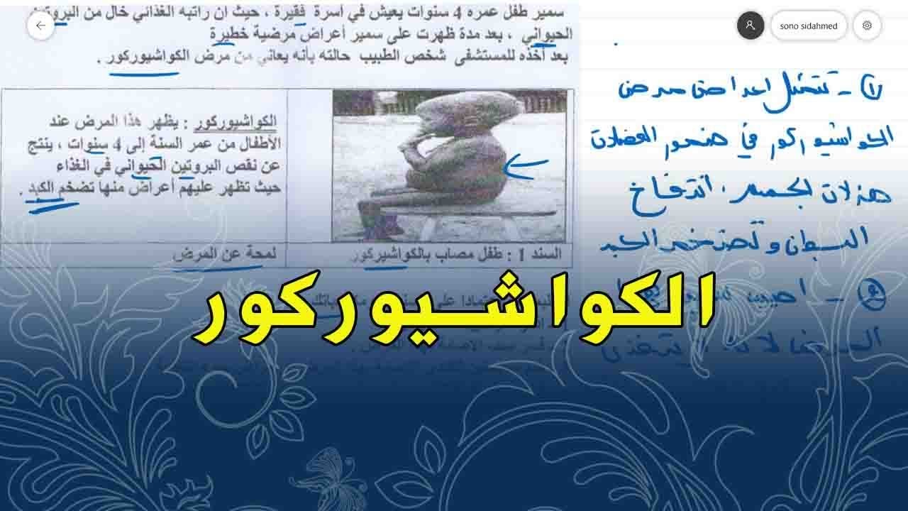علوم طبيعية للسنة الاولى متوسط تمرين على امراض سوء التغذية الكواشيوركور