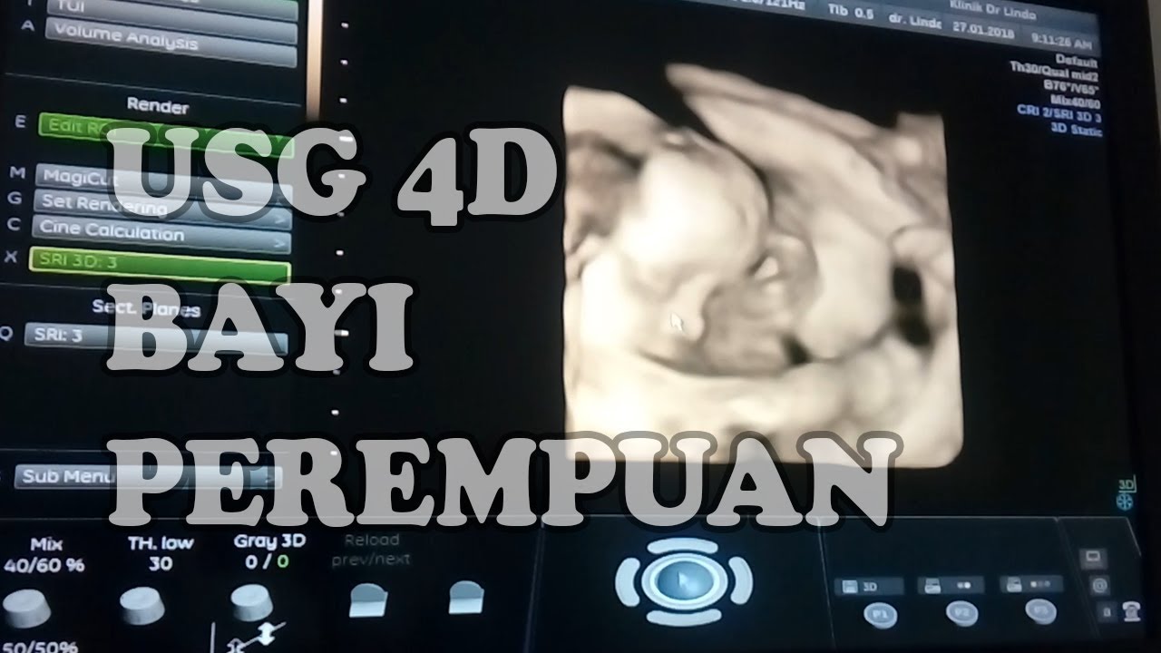 Usg 4d Bayi Perempuan Youtube