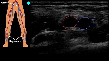 POCUS:  Venous Access - Part 1