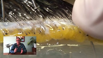 The WAW FUE System Explained By Dr Devroye