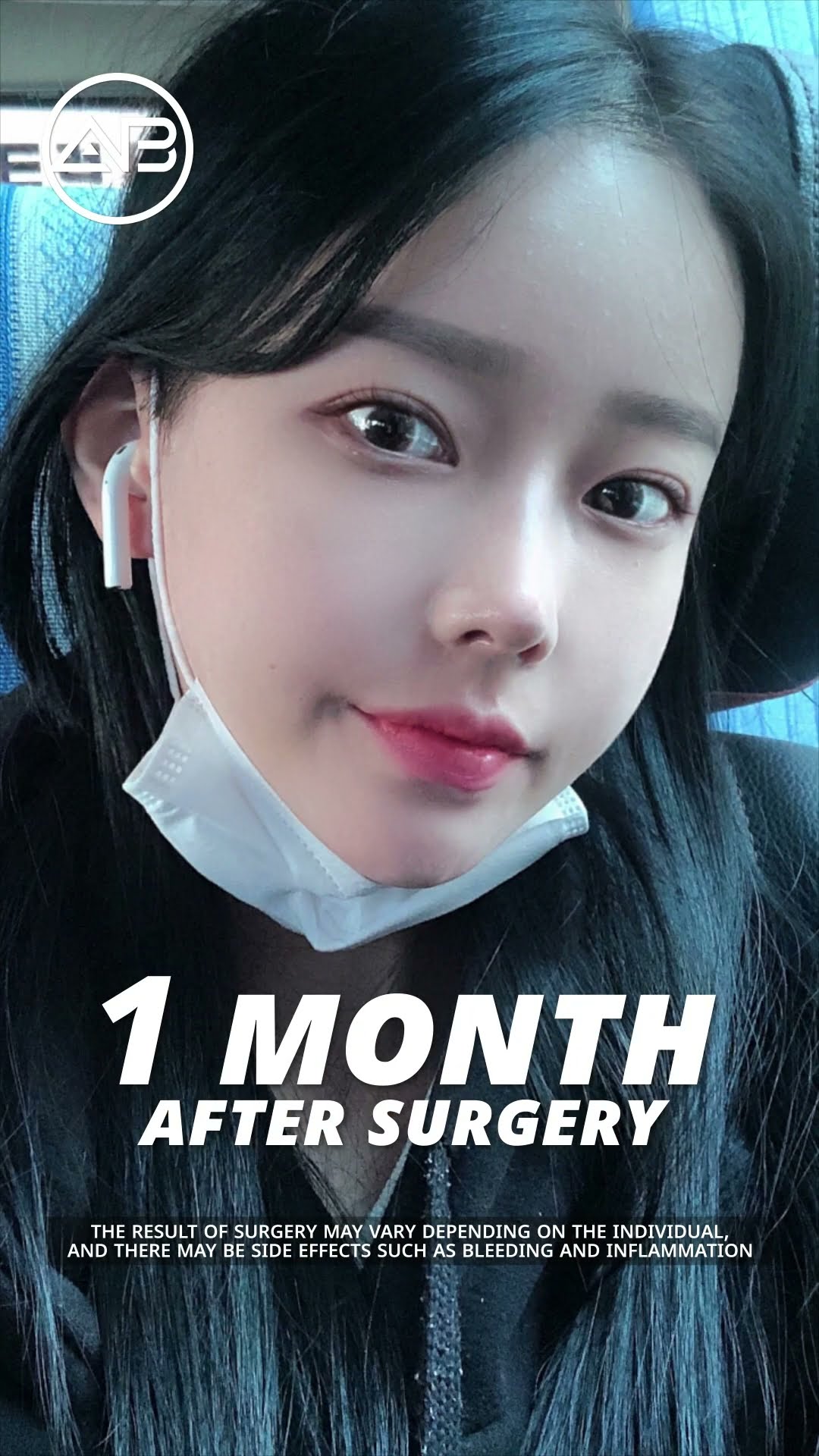 [Plastic surgery in Korea] Facial Contouring 3-set + Short Chin + Rhinoplasty #abplasticsurgery