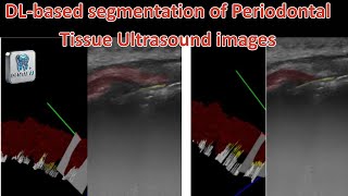 DL based segmentation of Periodontal Tissue Ultrasound images
