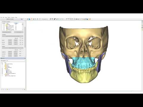 Orthognathics Part ll: Planning | PROPLAN CMF™