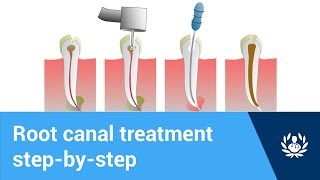 What are the steps of root canal treatment?