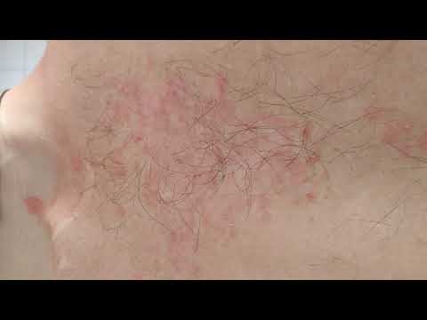 Video: Was ist der Unterschied zwischen seborrhoischer Dermatitis und Psoriasis?