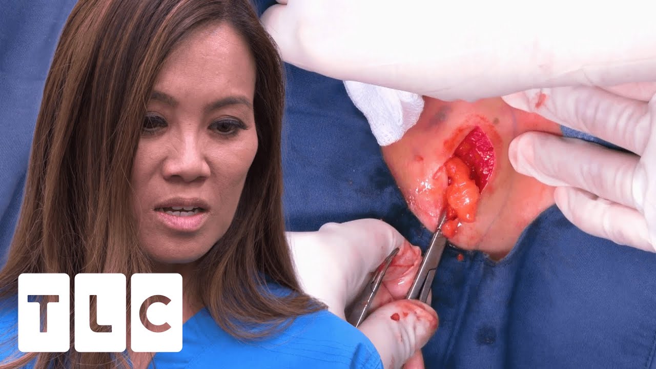 Dr. Lee ANGRY As Patient Performs Surgery On Themselves! | Dr. Pimple Popper | UNCENSORED | 18+