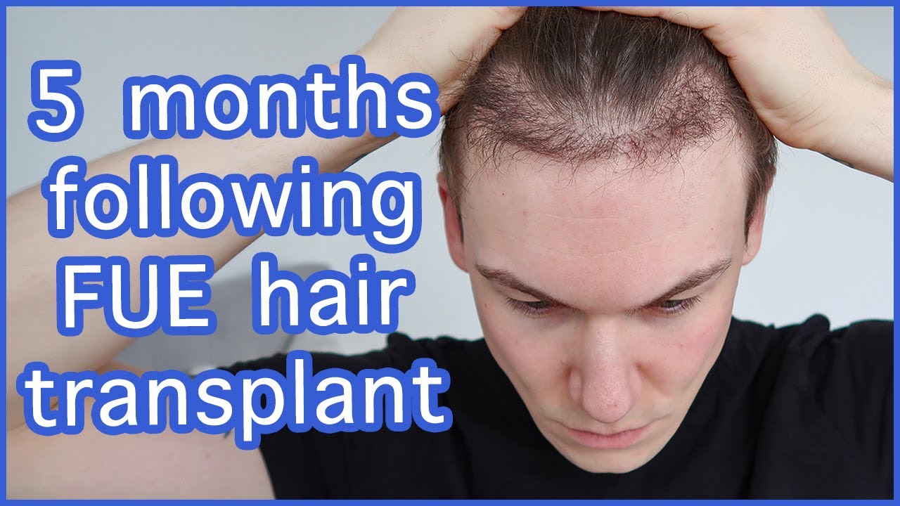 Hair Transplant Timeline What To Expect  Treatment Rooms