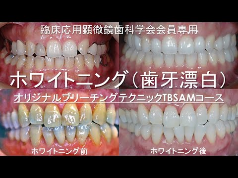 歯の漂白法 歯の漂白法にはどんな種類がある？ホワイトニングの効果や注意点