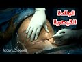 شاهد عملية الولادة القيصرية وقل سبحان الله الخالق Cesarean Section Surgical Technique HD Video شاهد عملية الولادة القيصرية وقل سبحان الله الخالق Cesarean Section Surgical Technique HD Video