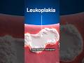Muh me safed daag? 😳 Dard nahi..phir bhi cancer ka signal ho sakta hai! 🚨 #Leukoplakia #MouthCancer