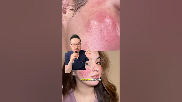 Why your rosacea cream isn’t working? 🥲#dermatologist #skincare