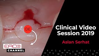 Aslan Serhat Clinical Video Session 2019