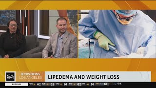 How lipedema can prevent weight loss