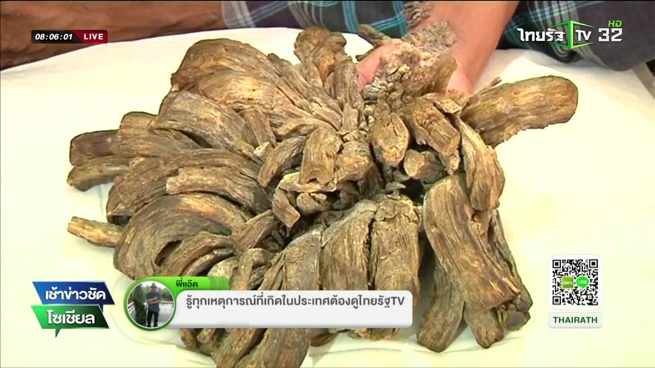 บังกลาเทศผ่าตัดมนุษย์ต้นไม้ | 14-03-59 | เช้าข่าวชัดโซเชียล | ThairathTV