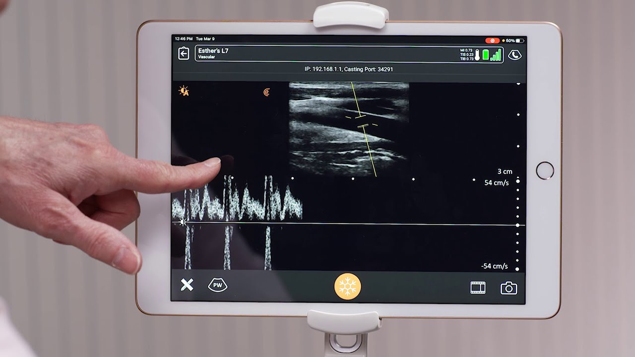 Clarius Feature PulsedWave Doppler Mode YouTube