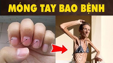 9 Dấu Hiệu Xuất Hiện Trên Móng Tay Cho Thấy Sức Khoẻ Của Bạn - Biết Càng Sớm Sống Càng Lâu | HYT3