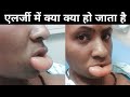 एलर्जी में शरीर के समय क्या होता हैं। allergy in hindi