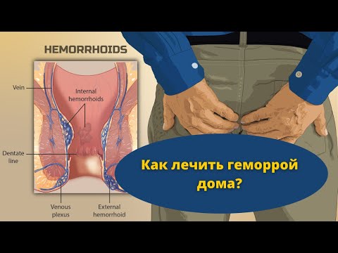 6 способов лечения геморроя в домашних условиях, у мужчин и женщин, доступных в 2021 г. без рецепта