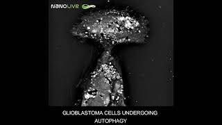 Glioblastoma cells undergoing autophagy