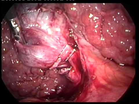 Laparoscopic Videos (edited-16)- Lap Chole In Cirrhotic Patient
