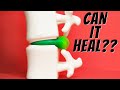 Can My Herniated , Bulging Disc or Sciatica Heal, How Long