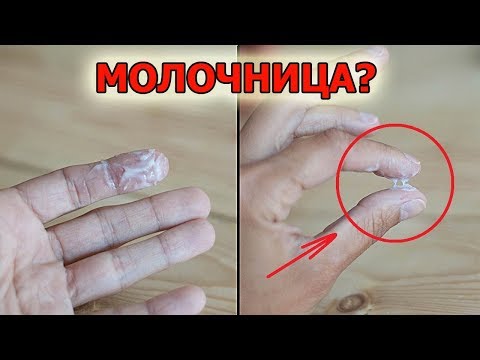Что такое молочница у женщин | Что такое кандидоз у женщин