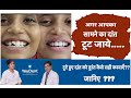 Cracked tooth के क्या क्या treatment ho सकते है जानिए इस  विडियो में-...... youdent hospital Jaipur