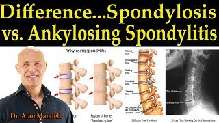 The Difference Between Spondylosis & Ankylosing Spondylitis - Dr Alan Mandell, DC