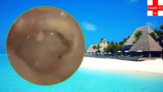 large ear wax extraction new 2019