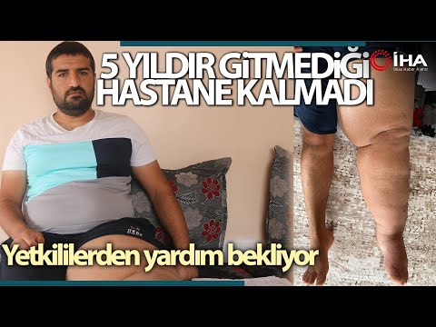 Kaza Sonucu Ayağı Şişen Genç Doktorlardan Çare Bekliyor