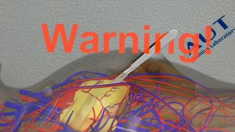 Mixed Reality Surgical Navigation with Warning function using Microsoft HoloLens