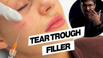 Under Eye Filler Before & After (Cannula, Tear Trough)